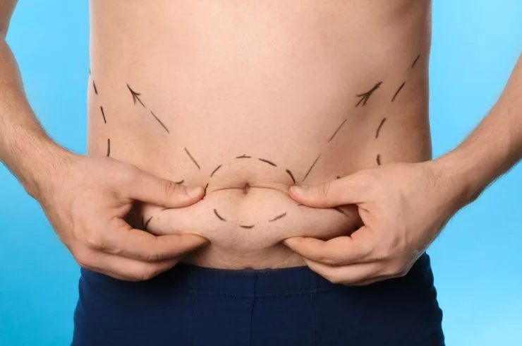 ABDOMINOPLASTY