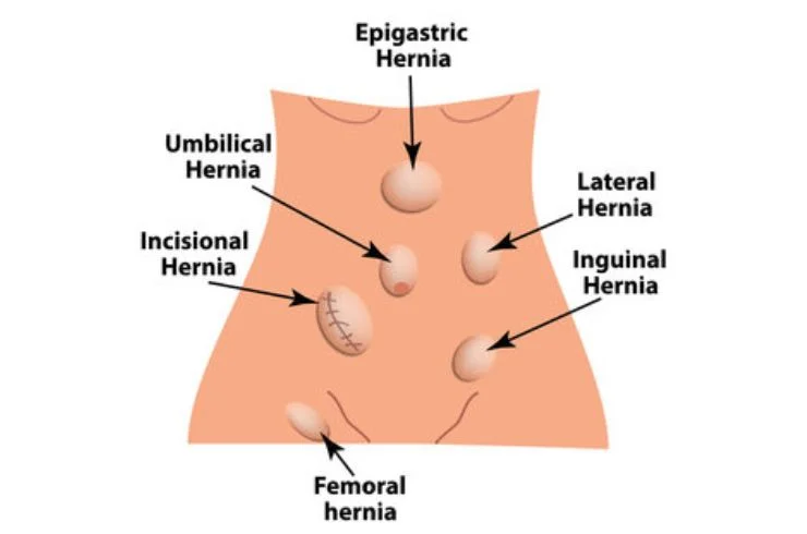 INCISIONAL HERNIAS