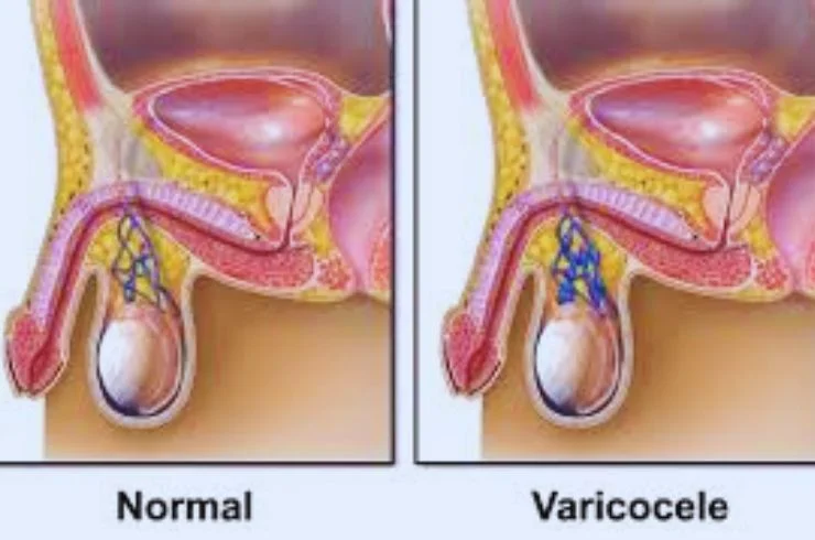 VARICOCELE